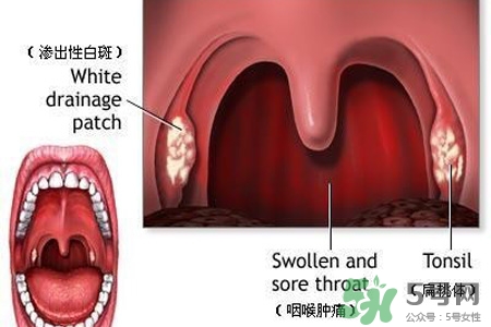 咽喉炎吃什么藥最好？咽喉炎吃什么藥好的快？