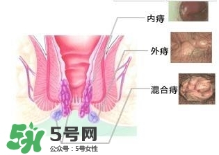 痔瘡吃什么藥效果好？痔瘡吃什么藥好得快？