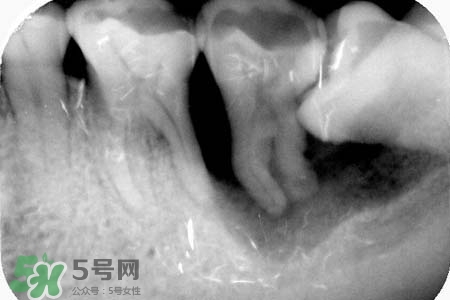 智齒會引起耳鳴嗎？耳鳴跟智齒有關(guān)系嗎？