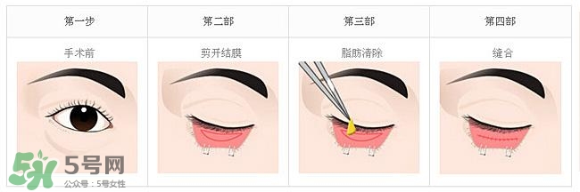 眼袋是怎么形成的？手術去眼袋安全嗎