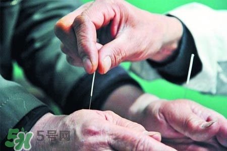 沒病可以針灸嗎？沒病可以扎針嗎？