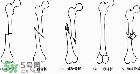 骨折吃什么好得快？骨折后注意事項(xiàng)