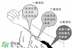 燙傷起泡要挑破嗎？燙傷起泡怎么處理？