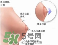 乳腺增生怎么根治 得了乳腺增生能根治嗎