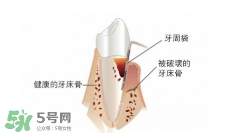 牙周炎怎么治療？牙周炎怎么治好