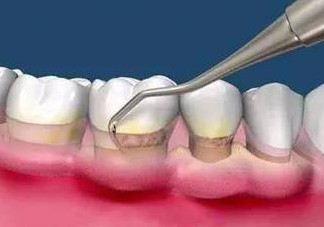 牙周炎怎么治療效果最好？牙周炎怎么治療小偏方