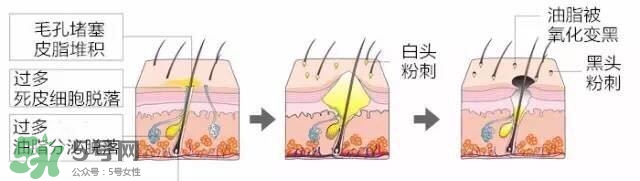 鼻子長黑頭是因?yàn)槭裁丛?如何找到適合自己的去黑頭方法