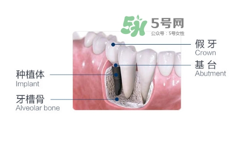 種植牙費(fèi)用多少錢？國(guó)產(chǎn)種植牙價(jià)格