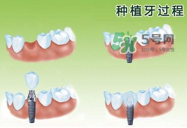 種植牙費(fèi)用多少錢？國(guó)產(chǎn)種植牙價(jià)格