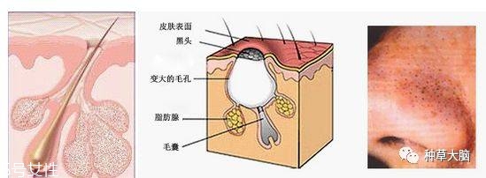 小氣泡是什么 小氣泡去黑頭有效嗎