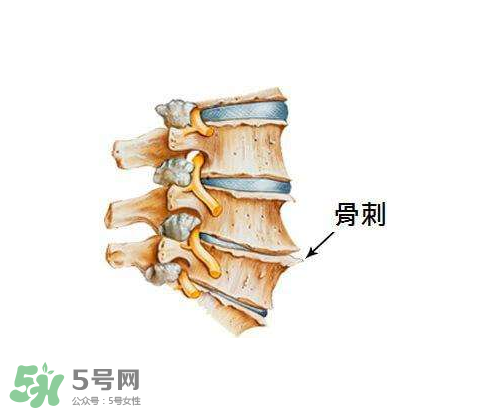 骨刺是怎么形成的？骨刺怎么治療？