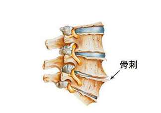 骨刺是怎么形成的？骨刺怎么治療？