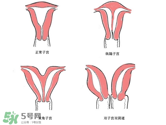 雙子宮是什么意思？雙子宮可以順產(chǎn)嗎？