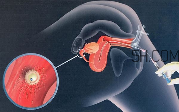 人工授精取卵子怎么取？人工授精男人怎樣取精？