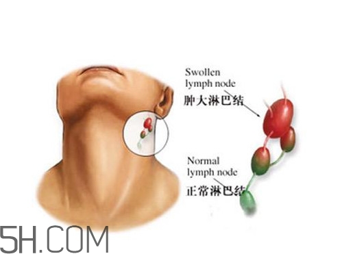 淋巴癌能活多久？淋巴癌癥狀有哪些