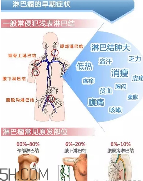 淋巴癌是怎么回事？淋巴癌如何診斷