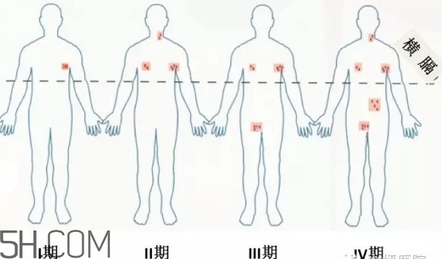 淋巴癌是怎么回事？淋巴癌如何診斷