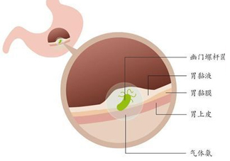 幽門螺桿菌的癥狀有哪些表現？幽門螺旋菌怎么治療
