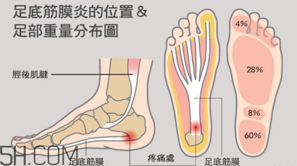 早上下床腳后跟痛是怎么回事_怎么辦