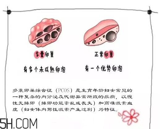 多囊卵巢生不了？多囊卵巢懷孕要看準(zhǔn)時(shí)間