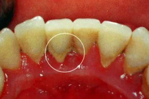 牙結(jié)石能自動脫落嗎？除了洗牙別無他法