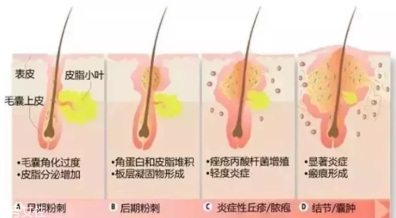 封閉性粉刺的發(fā)病機制是什么？角質(zhì)層太厚