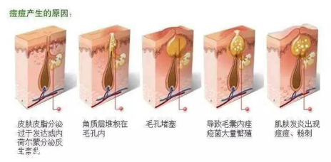 頑固痘痘怎么消除？油皮為什么反復(fù)爆痘？