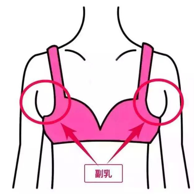 假副乳怎么形成的 3個(gè)不良習(xí)慣