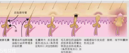 臉上閉口太多怎么辦 臉上長閉口怎么調(diào)理