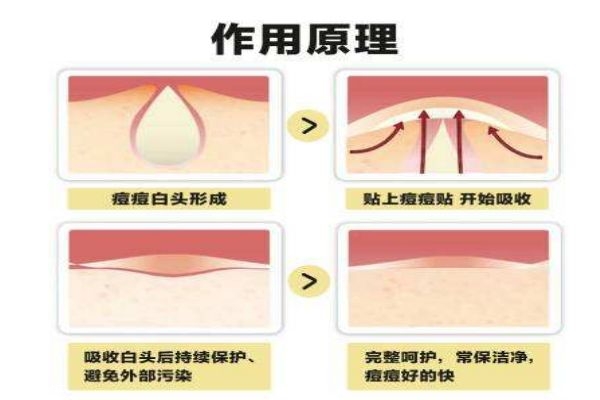 痘痘貼的工作原理有什么 痘痘貼應該怎么用呢