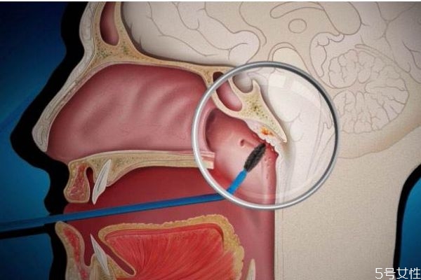 什么是鼻咽癌呢 鼻咽癌有什么危害呢