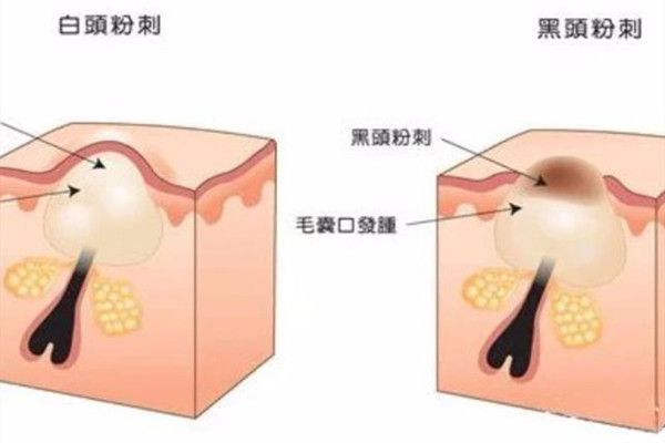 毛角周化和閉口的區(qū)別 毛角周化和閉口怎么區(qū)分