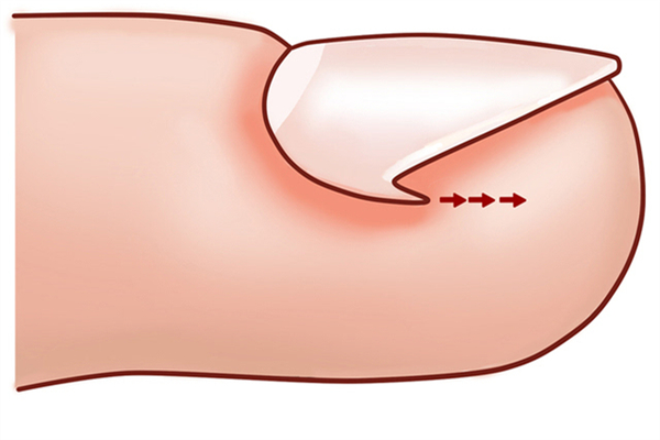 甲溝炎指甲長出來就好了嗎 甲溝炎指甲長肉里好深怎么辦