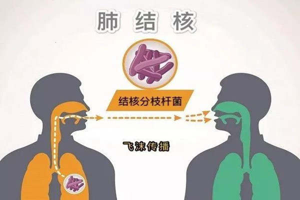 肺結(jié)核會引起淋巴結(jié)腫大嗎 肺結(jié)核會引起胸腔積液嗎