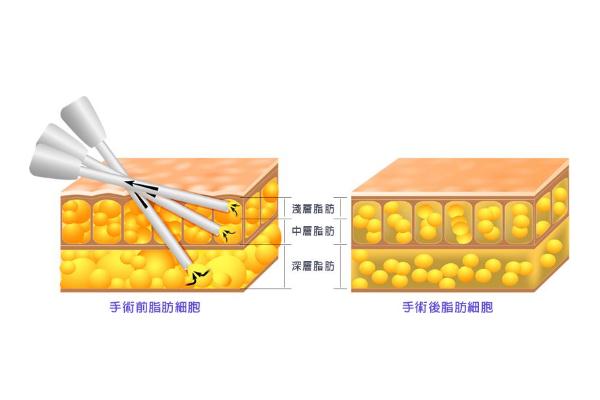 抽脂肪對身體有什么副作用 抽脂手術大概花多少錢