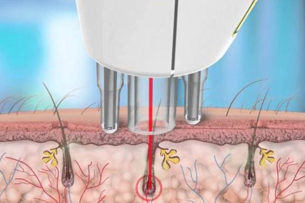 激光脫毛和冰點(diǎn)脫毛有什么區(qū)別 激光脫毛有什么后遺癥