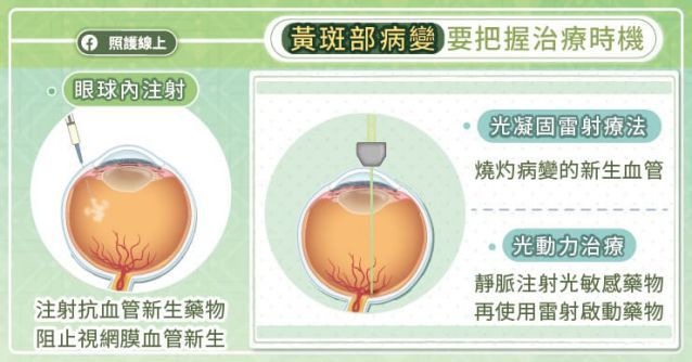 黃斑部病變的原因與癥狀 測你的黃斑部病變風險