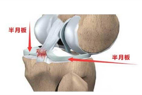 徐夢(mèng)桃摘金背后:半月板切除70% 半月板損傷怎么造成的