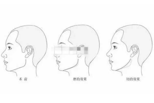 顴骨內(nèi)推的釘子需要取出嗎 顴骨內(nèi)推是幾級手術(shù)