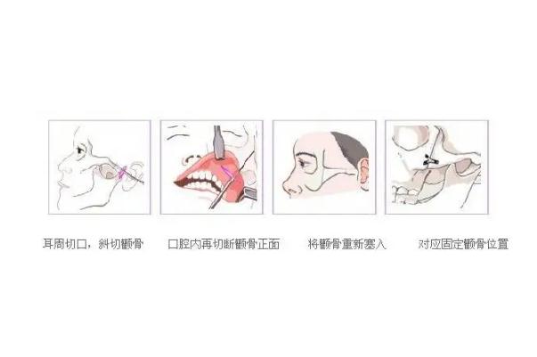 顴骨內(nèi)推的釘子需要取出嗎 顴骨內(nèi)推是幾級手術(shù)