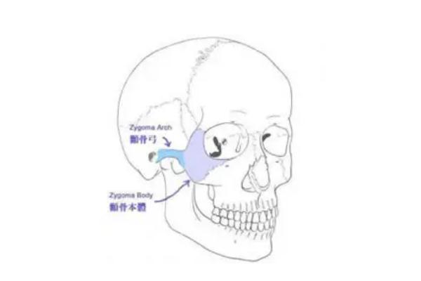 顴骨內(nèi)推手術(shù)多少錢啊 顴骨內(nèi)推后遺癥